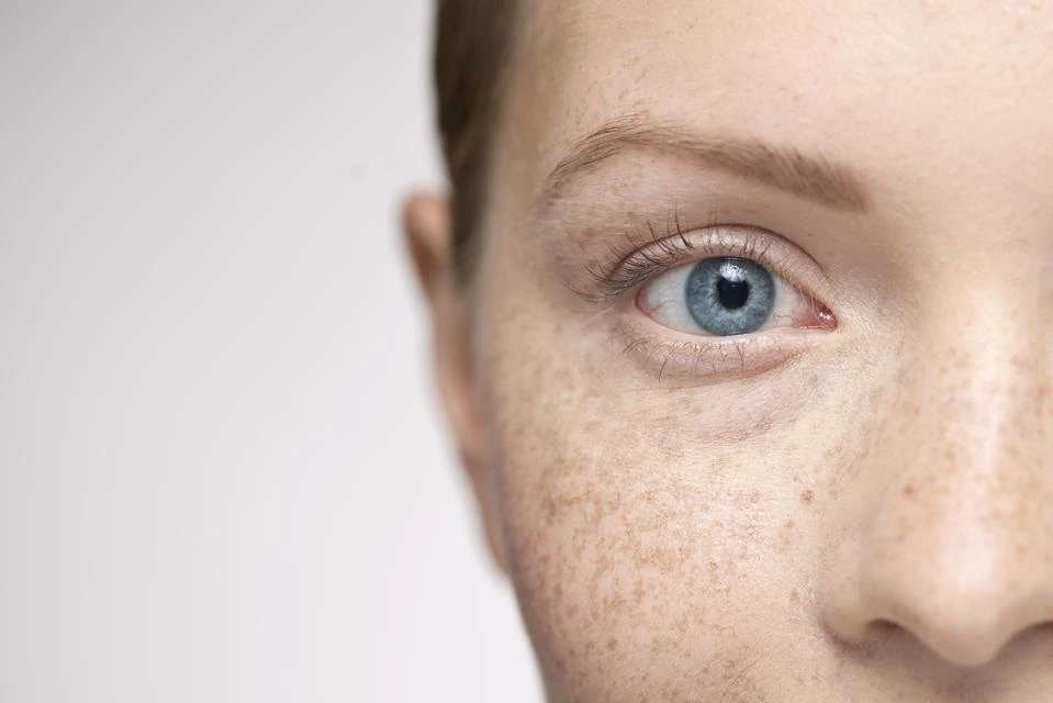 Understanding Sun Damage: How UV Rays Alter Skin and How CryoPen Can Reverse It Welwyn-Garden-City