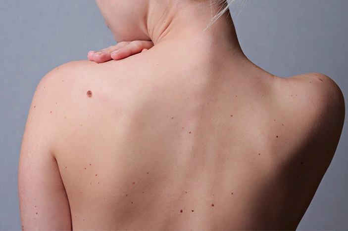 The Skin’s Healing Journey After CryoPen Sun Damage Treatment Welwyn-Garden-City