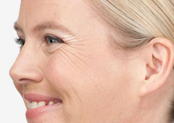 CryoPen Precision vs. Laser: Which Is Better for Sun-Damaged Skin? Welwyn-Garden-City