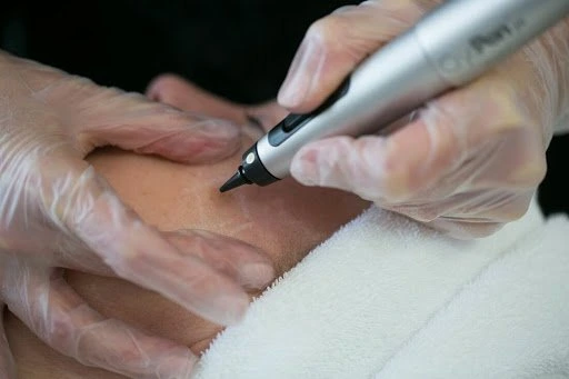 The CryoPen Technology Explained: How Extreme Cold Removes Sun-Damaged Skin Cells Welwyn-Garden-City