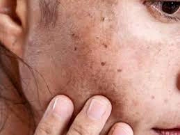 Why CryoPen Works Best for Isolated Sun Spots and Pigmentation Welwyn-Garden-City