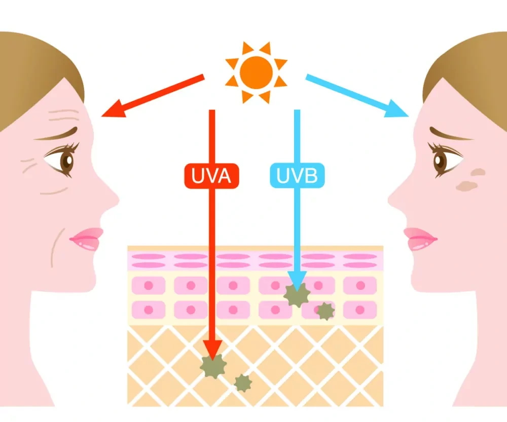 Understanding Sun Damage Welwyn-Garden-City - Why Should Sun Damage Be Treated Early? Welwyn-Garden-City